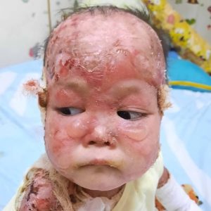Help Lily Fight EB